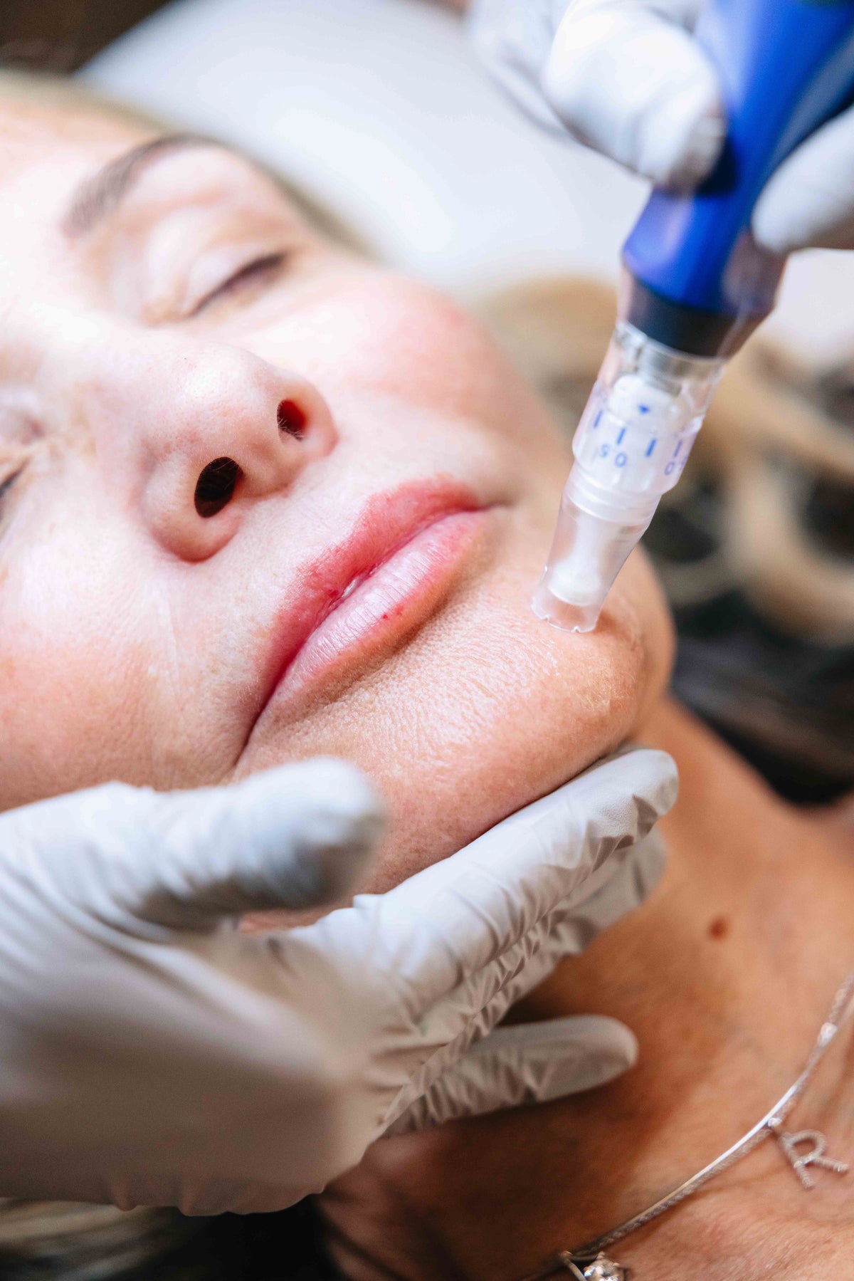 SkinPen Full Face 4-Pack